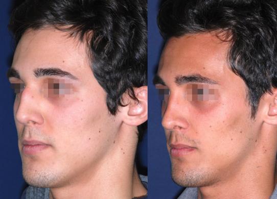 before and after rhinoplasty male 4