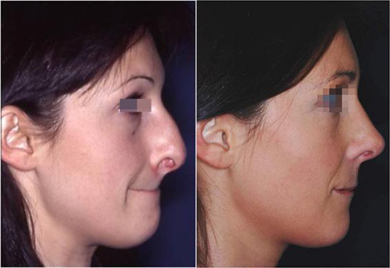 nasal tip surgery before and after 1